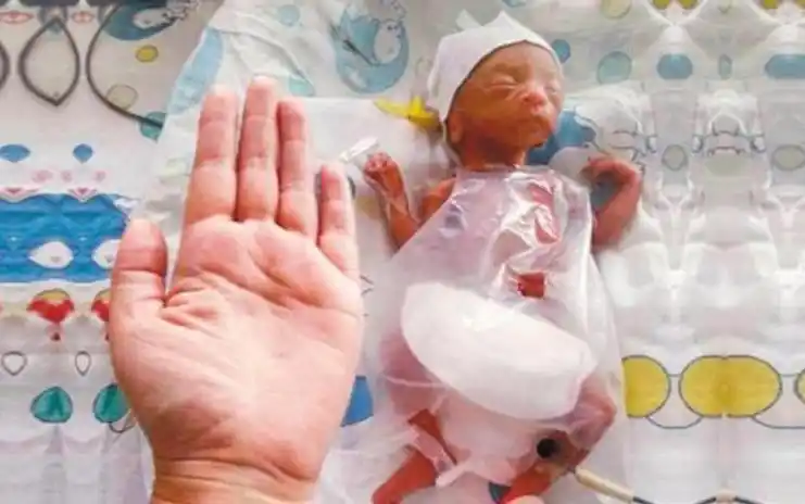 孕妇26周胎膜早破早产, 孩子出生后只有巴掌大小