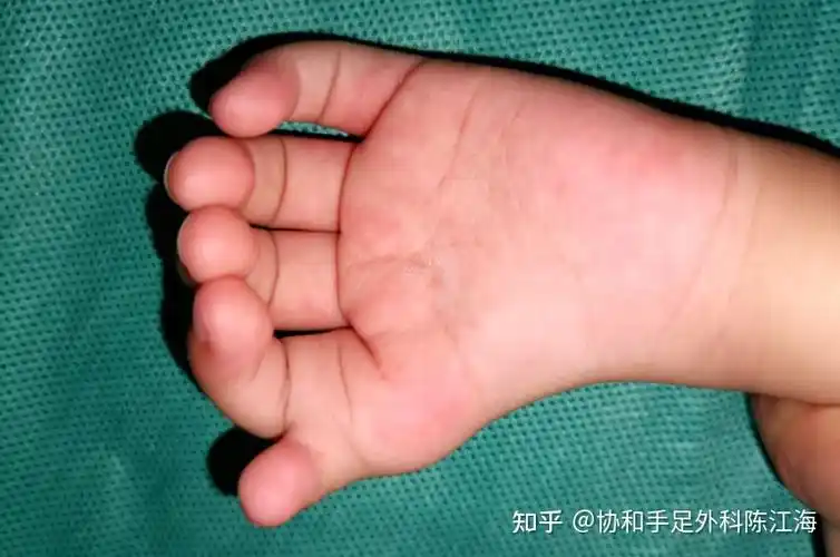 漂浮拇成功保五指案例6小女孩患先天性特殊型漂浮拇历经两次复杂手术