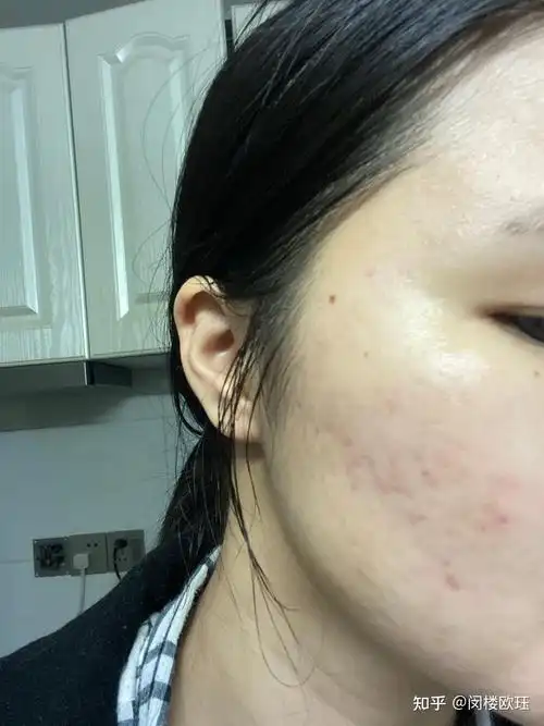 19岁的女生皮肤很差怎么办