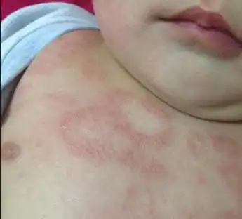 为什么天气热湿疹反复发作(为什么天气热湿疹就又出来了)