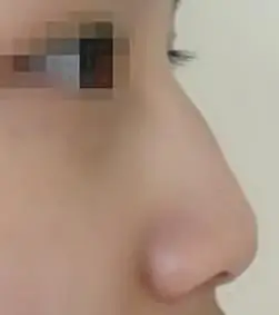 鼻梁凸起一块好高,帮我看下是不是驼峰鼻?现在这.