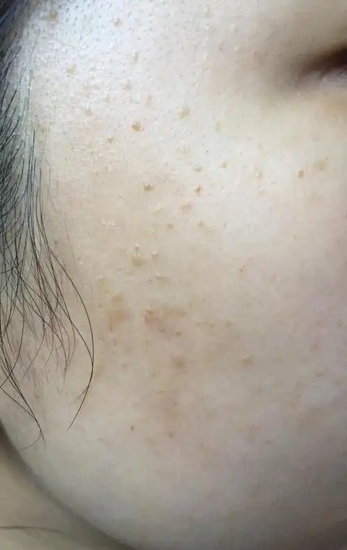 为什么扁平疣患者越来越多?它的传染性究竟有多强?