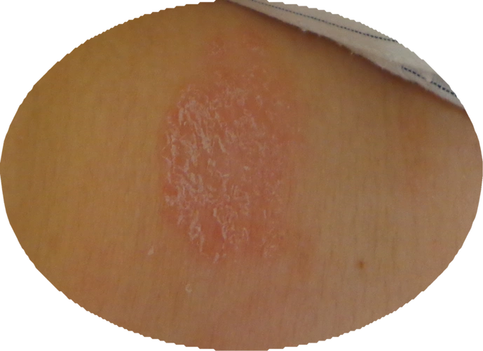 肩膀左边有一块皮肤发红,有3cm长,象起皮,触摸感觉较硬,有摩擦,1个多