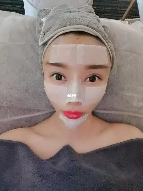 全脸脂肪填充第三天