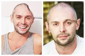 脑袋"摔扁"了 造个金属脑壳