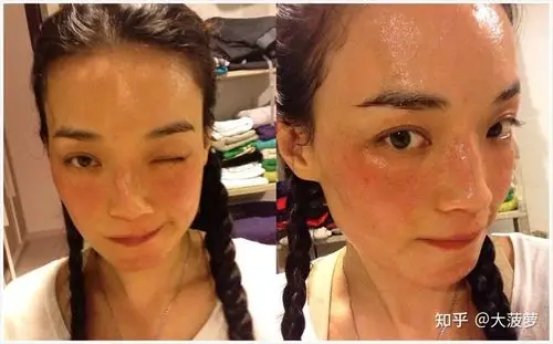 看到过皮肤不好但是觉得是好看的女生吗?