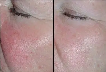 脸上有红血丝怎么解决