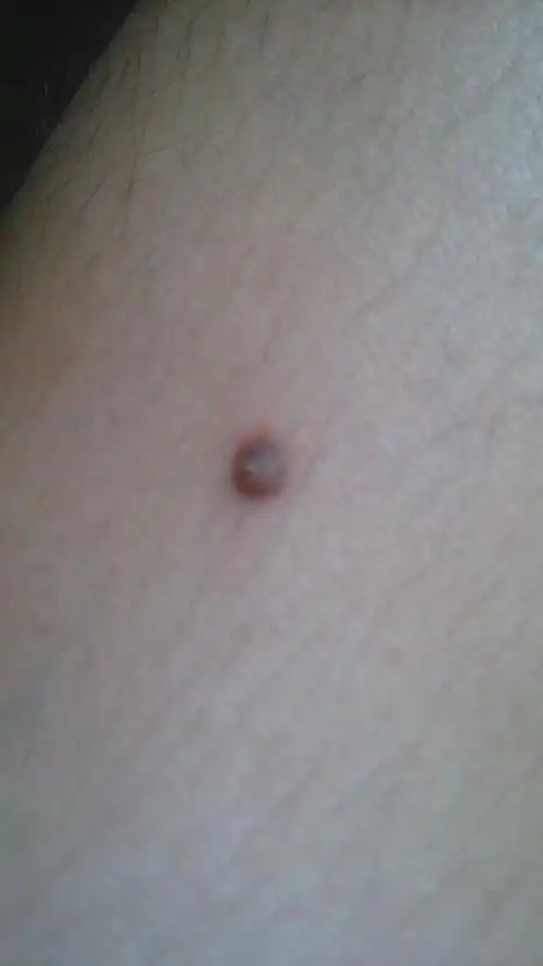 小腿上长了个肉瘤,我该怎么办啊,附图