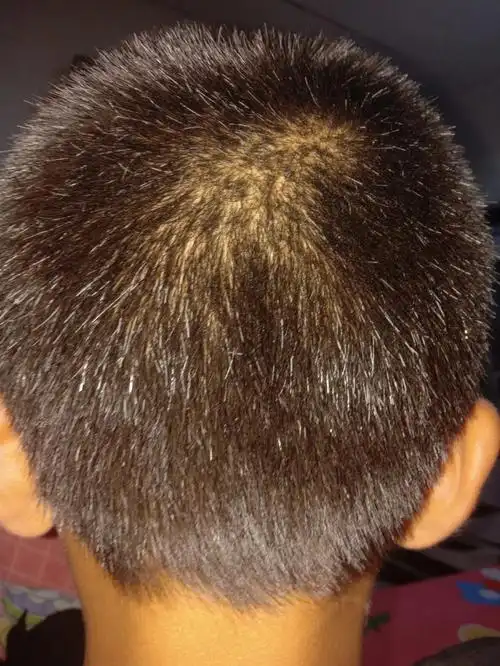 孩子有白头发怎么办 ?