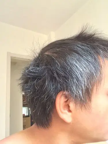 这么严重的白发.怎么样治疗.