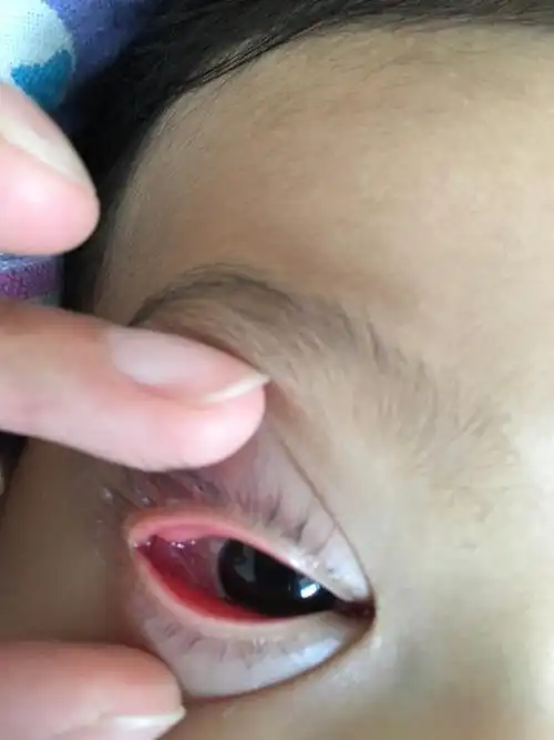三岁儿子右眼睑红,发现当天晚上姥姥误把红霉素软膏涂点在眼睛里,第