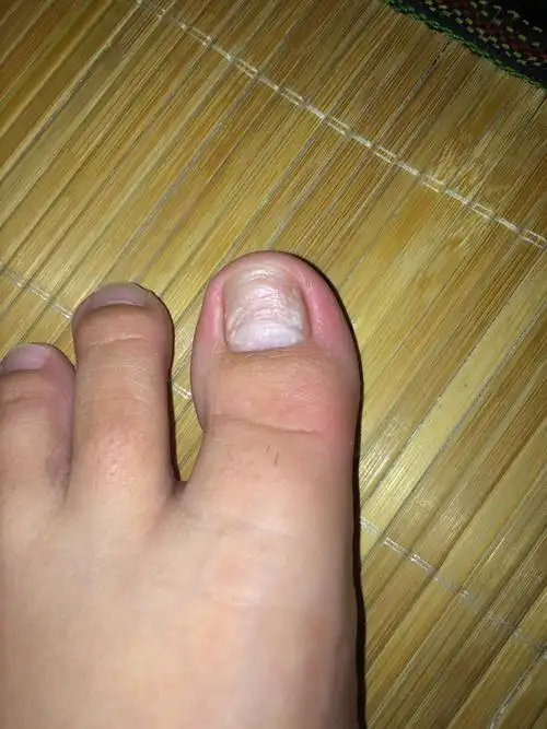 为什么大脚趾突然变成这样了啊,而且怎么长都长不了像以前那种光滑的