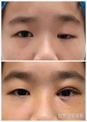 大小眼除了割双眼皮还有别的办法吗?