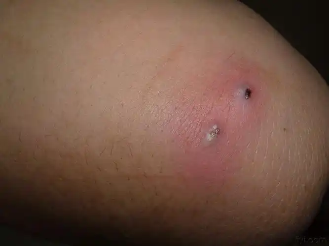 毛囊炎        运动员