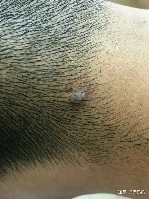 有谁知道瘊子是什么它为什么会长出来有什么危害吗