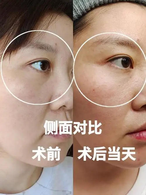 嗨体xiongmaozhen测评一针抚平泪沟衰老感哈喽我是半仙儿不定期分享医