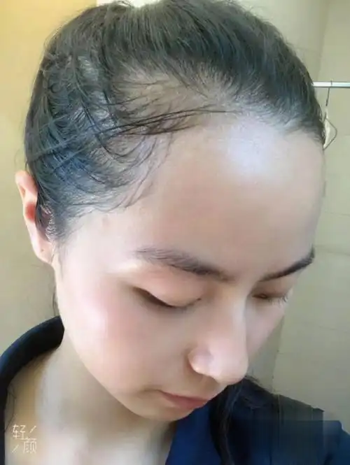 女医生分享发际线高怎么办发际线后移怎么办多图