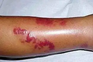 小腿丹毒的症状图片 - 搜狗图片搜索