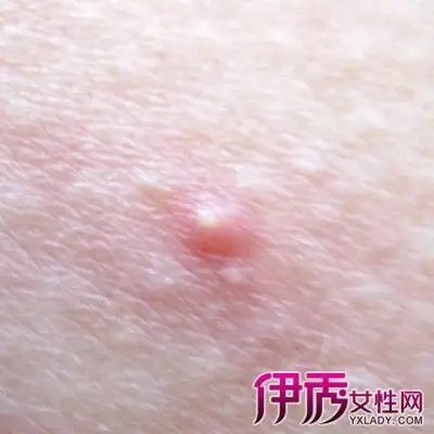 【图】毛囊炎治疗方法有哪些? 3大方法教你如何治疗及预防