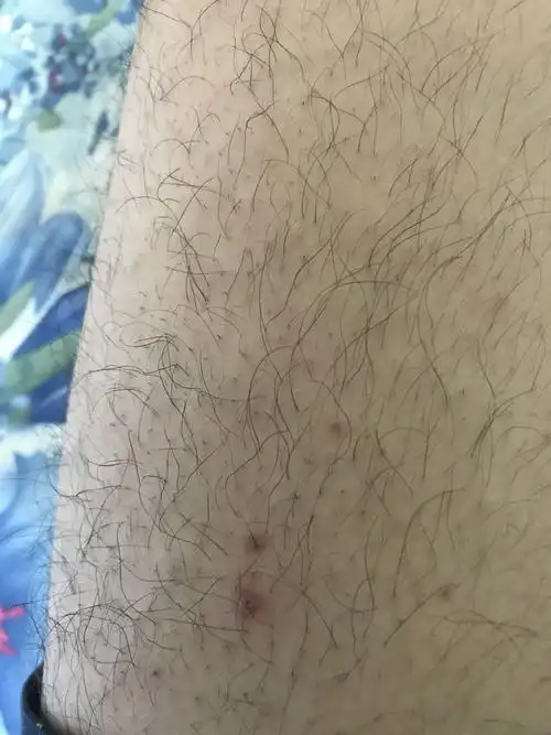 大腿毛孔长痘有刺痛不知道怎么回事,还有一些小红点,摸上去刺刺的