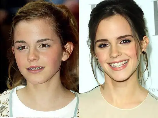 娱乐圈明星整牙变形记明星牙齿矫正前后对比大盘点