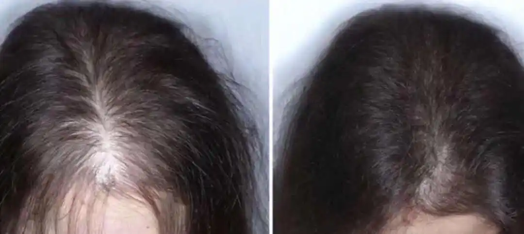 湄潭mini生发植发效果对比,效果看得见-案例分享-28美容生发网