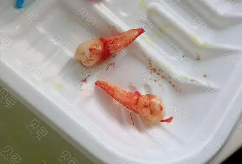 虎牙矫正拔牙疼吗分享我的拔牙和带牙套经历