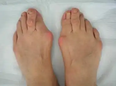 经常穿高跟鞋脚趾会变形是真的吗医生脚趾外翻不容小觑