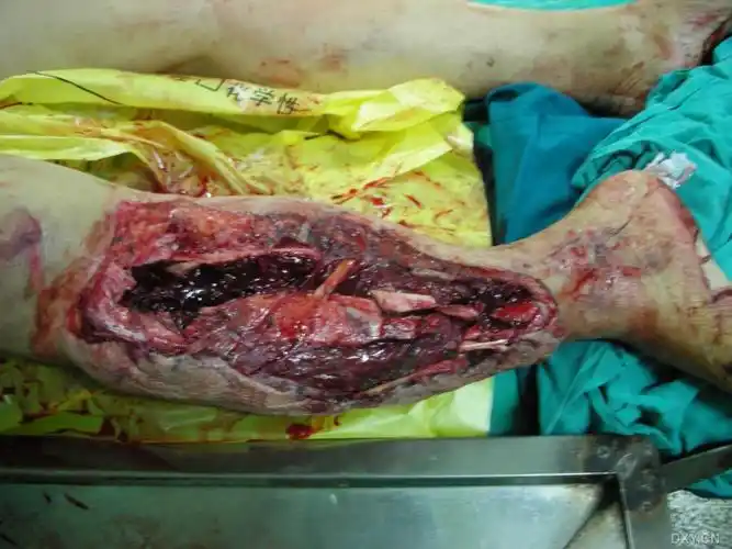 小腿严重碾压伤,欢迎讨论 [精华]