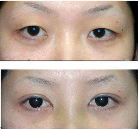 割双眼皮和埋线哪个好?