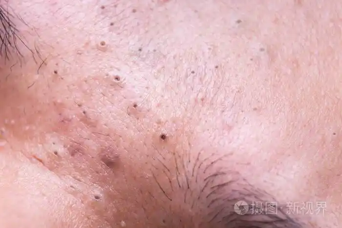 青少年鼻梁上丑陋的粉刺黑头
