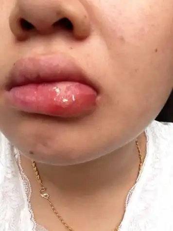 2014-05-14 梁定周 医师 我现在怀孕两个半月,产检检查出单纯疱疹