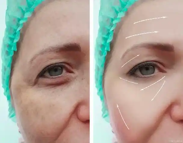 嗨体祛泪沟是什么?效果如何?好不好?