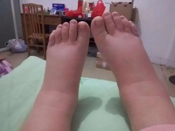医生教你如何辨别肾性水肿?