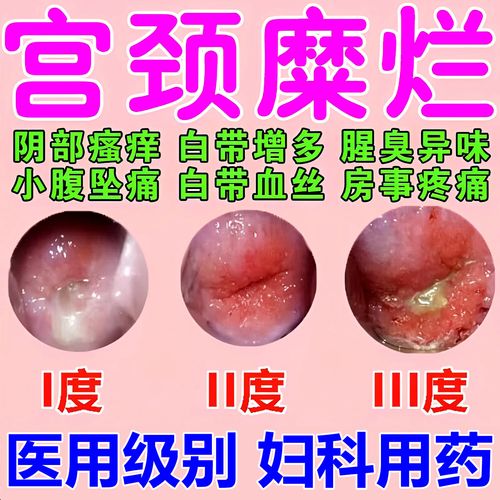 宫颈糜烂妇科用药二度三度消糜栓妇科专科用药妇科炎症滴虫性霉菌性
