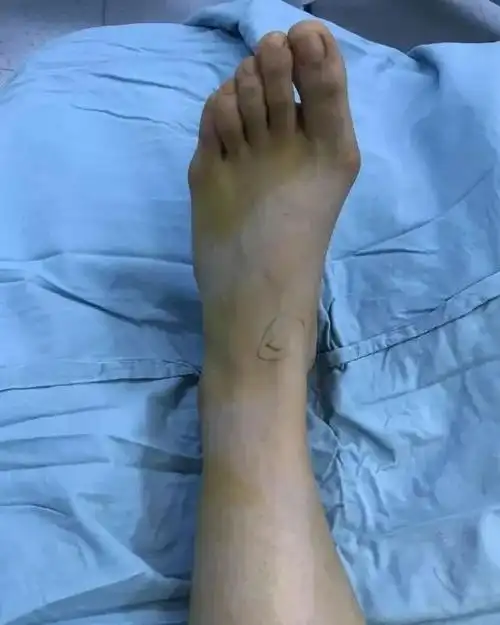 青少年踇外翻是啥