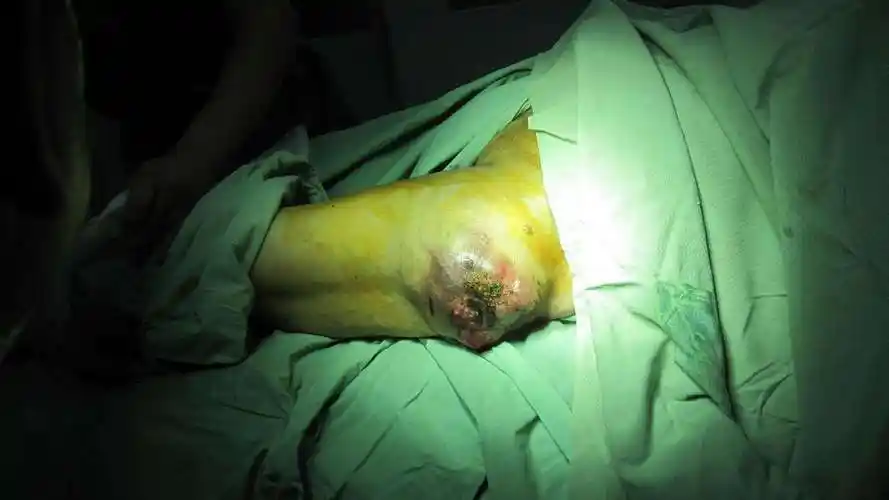 图片左大腿横纹肌肉瘤手术切除一例