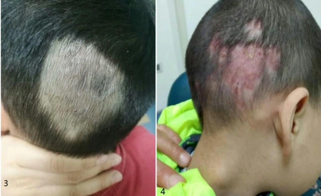 宝宝有苦说不出,浅谈精神行为障碍性儿童皮肤病:拔毛癖