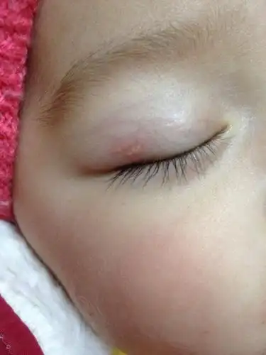 宝宝眼皮上长了几个小豆豆,7个月大