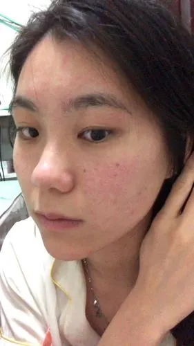 求助拯救皮肤屏障受损严重后毁容式狂爆皮