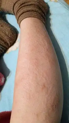 小腿皮肤瘙痒,太热(烤火炉,热水澡反反复复)造成的,抓的太厉害,又去洗