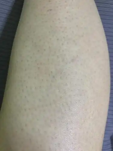 求助仙女们告诉我腿上毛孔粗大要怎么办图片可能引起不适慎入