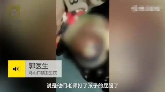 6岁女孩因作业反复出错,屁股被老师打到发紫,老师:情绪失控