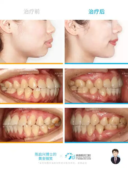 牙齿-侧面及口内对比.jpg