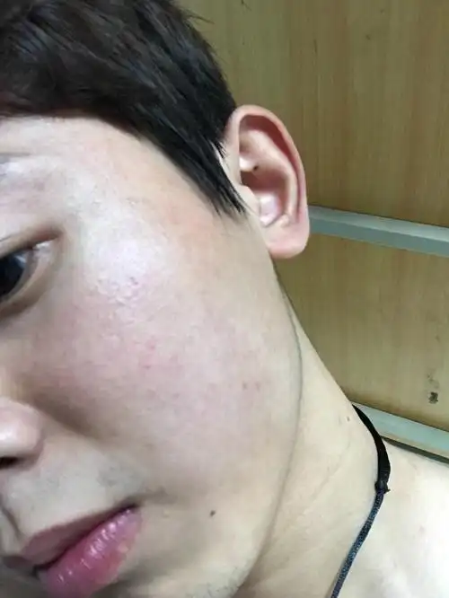 四五年前我用不好的化妆品过敏过然后脸就很红比较痒慢慢