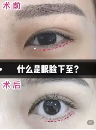 眼角下至前后对比