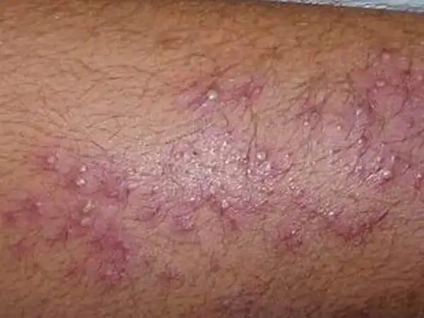 毛囊炎的症状图片是什么