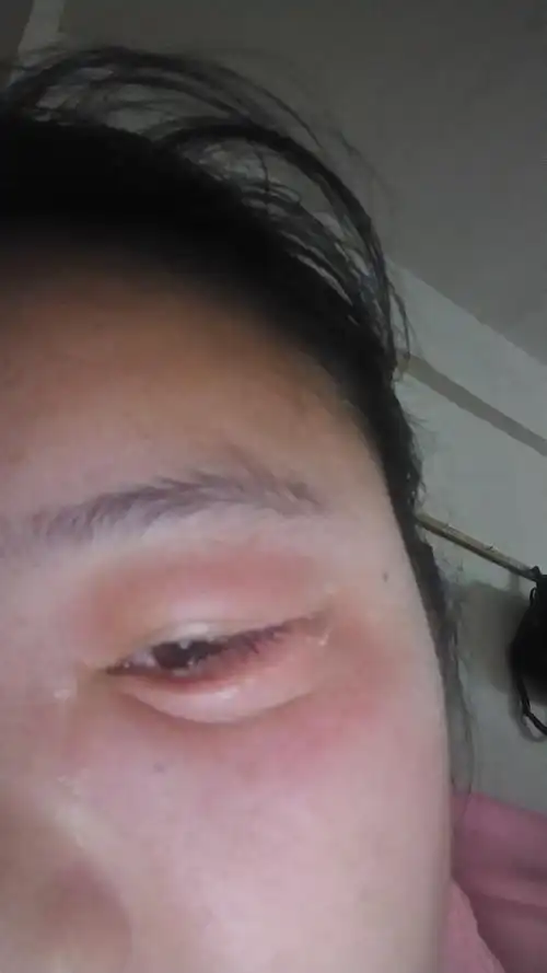 导致眼睑浮肿肾炎在引起眼皮浮肿的同时,还会伴有下肢水肿贫血等此时