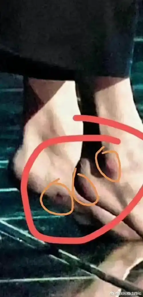 王一博跨年晚会脚受伤了