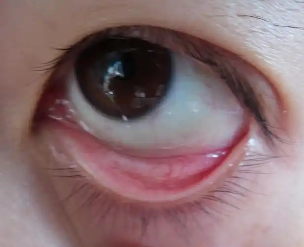 希望能给出正常的与结膜炎的对比图示,自己在家也能看出来究竟还有事